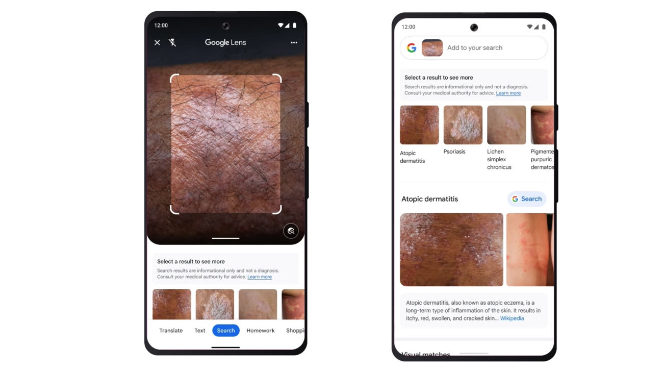 La Google Lens peut désormais reconnaître les maladies de la peau